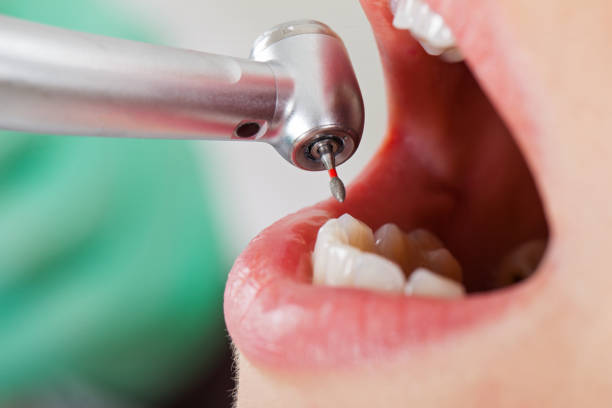 Best Emergency Wisdom Tooth Extraction in Munster, IN